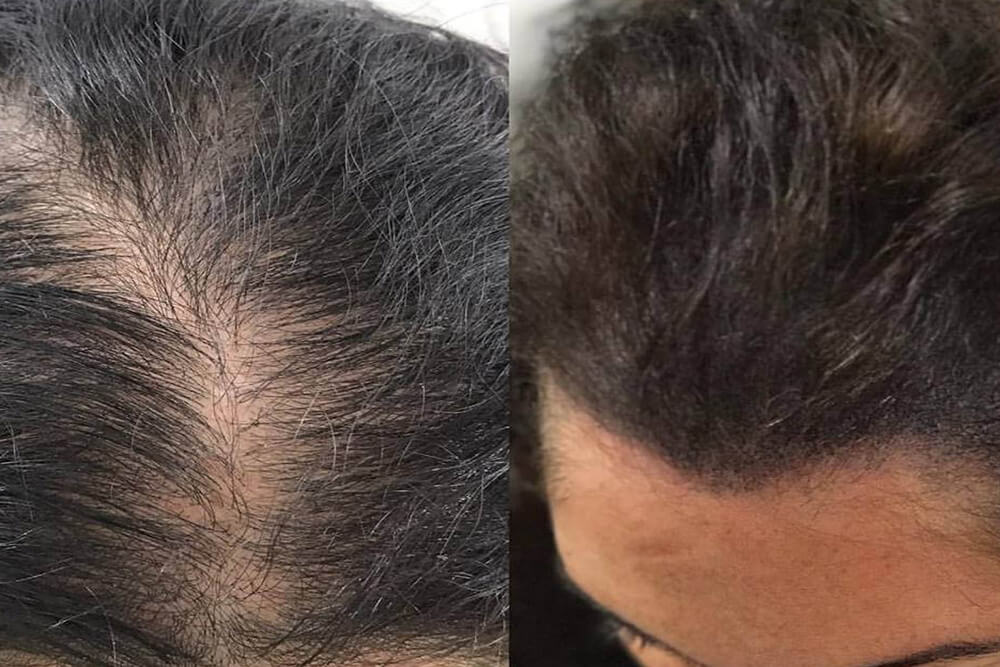 scalp micropigmentation for women